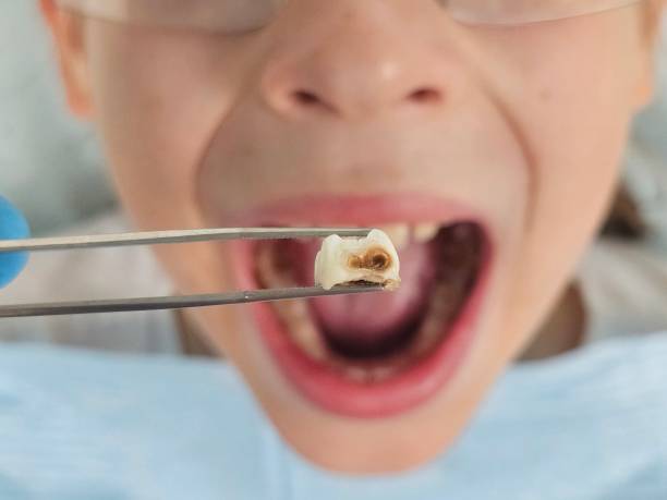 Best Emergency Dental Care for Broken or Chipped Teeth in Marfa, TX